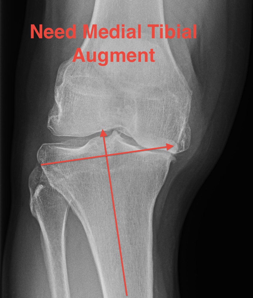 TKR Severe Varus Requiring Medial Augments